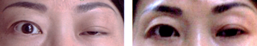 complicationofBotulinum Toxin 